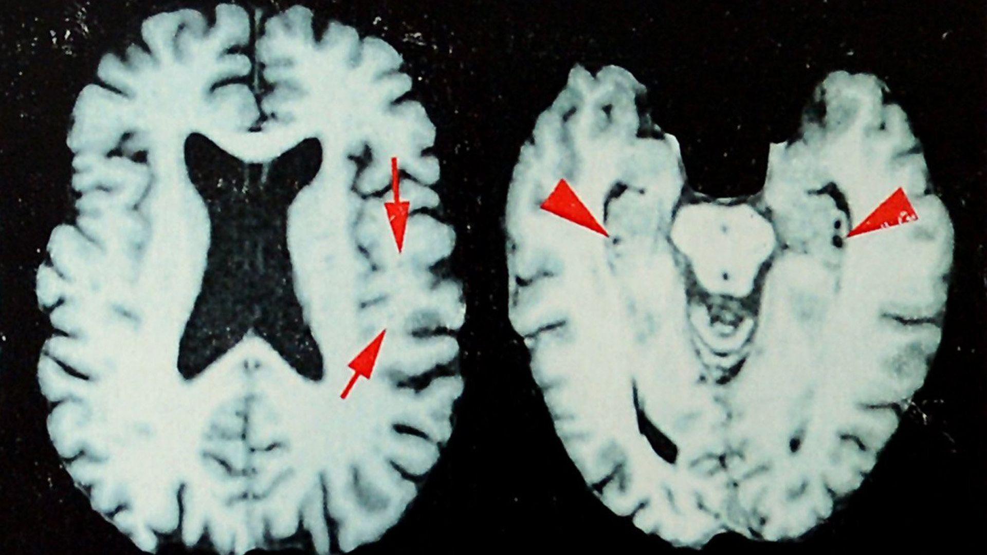 Neuro Crisis: Up to 97% of Former NFL Players May Have Endured Brain Disease