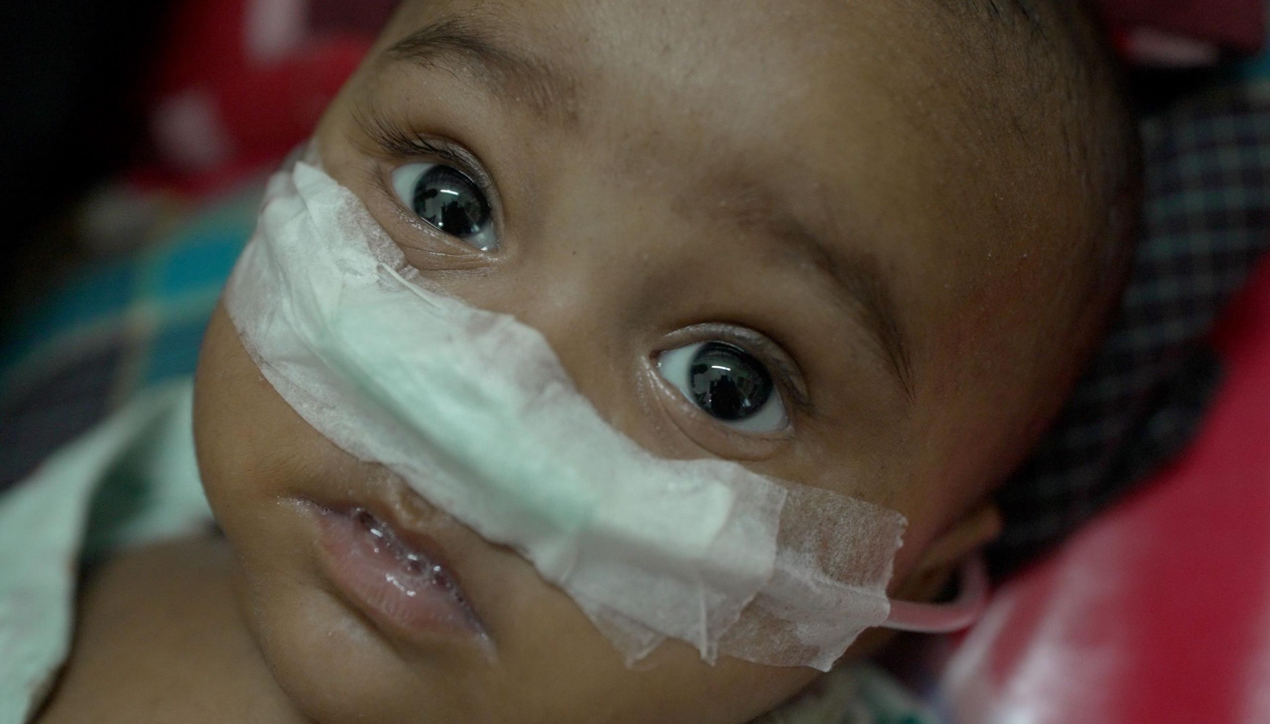 Bangladesh’s Measles Crisis: Kids in the Crosshairs